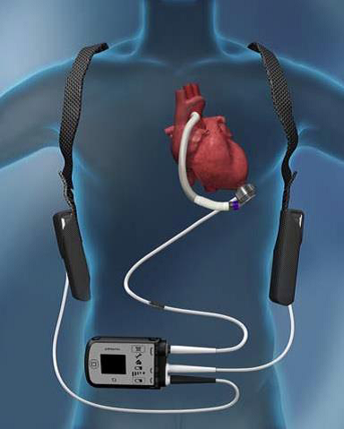 El Hospital La Fe implanta el dispositivo de asistencia cardíaca más avanzado como paso previo al trasplante